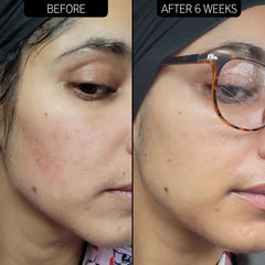 The Inkey List Redness Relief 10% Azelaic Acid Serum